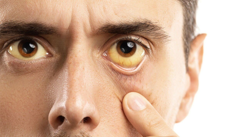 Eyes and Nutritional Deficiency , Warning Signs You Shouldn’t Ignore