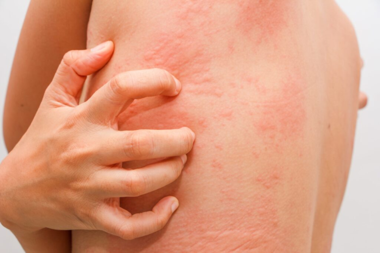 Cold Air Allergy (Cold Urticaria): Symptoms, Prevention, and Management