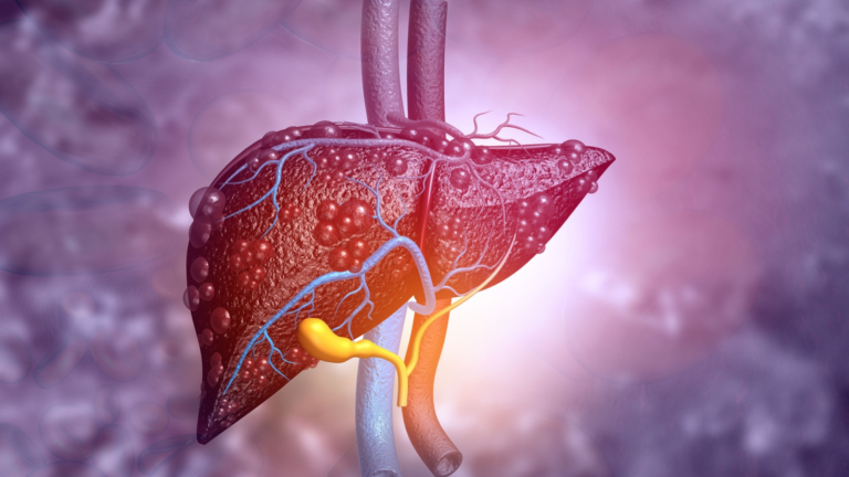 The Silent Epidemic: Understanding and Reversing Fatty Liver Disease