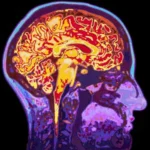 A shocking study: nanoplastic particles accumulate in human brains