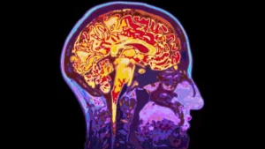 A shocking study: nanoplastic particles accumulate in human brains