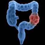 Most common among young people: Learn about the symptoms of colorectal cancer