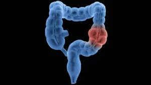 Most common among young people: Learn about the symptoms of colorectal cancer